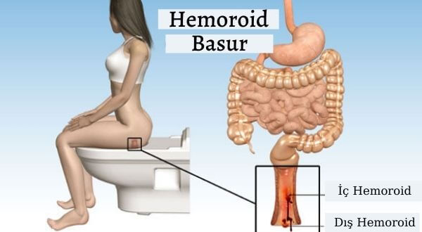 Hemoroid Nedir Neden Olur (1)