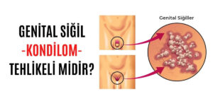 GENİTAL SİĞİL -KONDİLOM- TEHLİKELİ MİDİR (1)