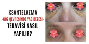 KSANTELAZMA NASIL TEDAVİ EDİLİR